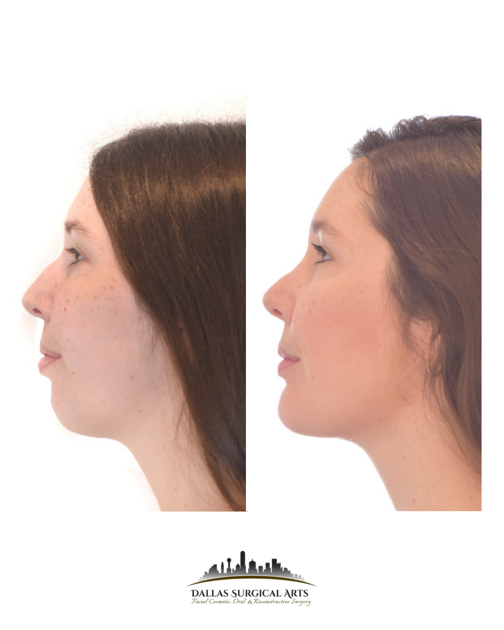 Dallas Genioplasty Cosmetic Surgeon Dr Randy Sanovich Dallas Surgical Arts