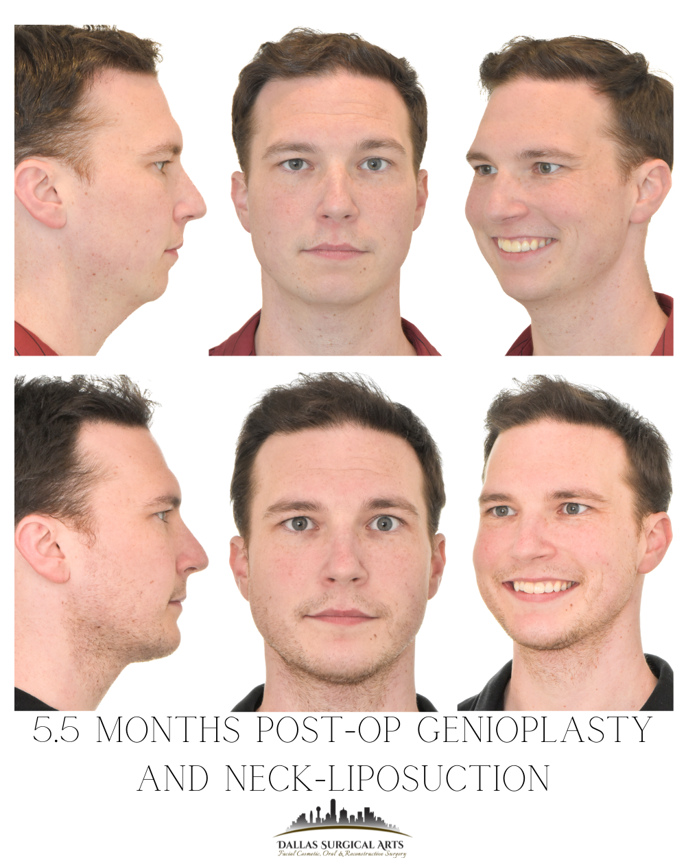 Dallas Genioplasty Cosmetic Surgeon Dr Randy Sanovich Dallas Surgical Arts